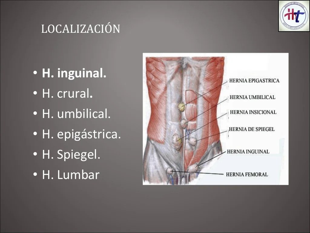 Hernia Inguinalis